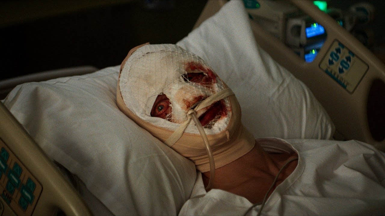 Matt Hagen está deitado em uma cama de hospital com a cabeça coberta por bandagens e um dos olhos machucado.